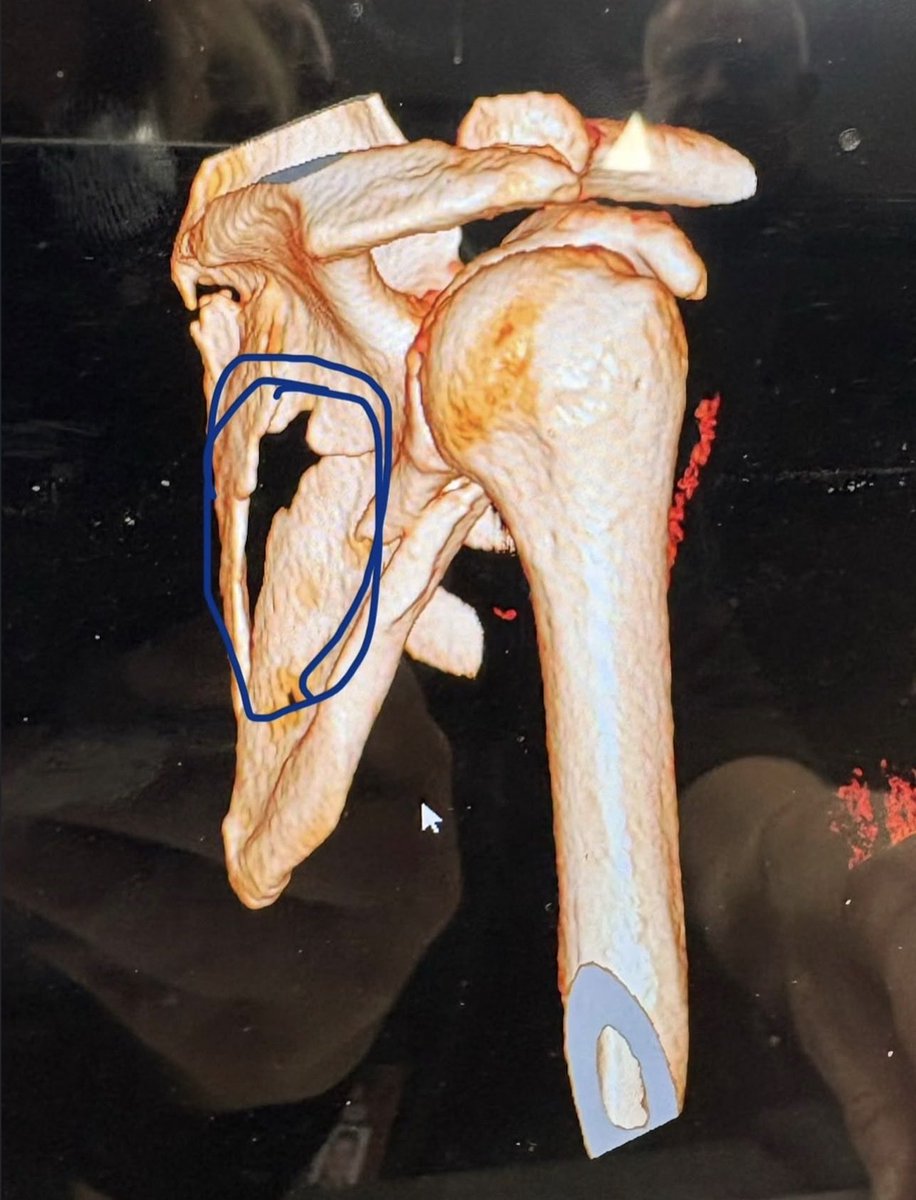 G59Hyatt's tweet photo. @austin1212 @BRIZEEMODE For you, this is fake? These are her skins definitely not fake. It’s a very major fracture. https://t.co/DirpiOtHaI