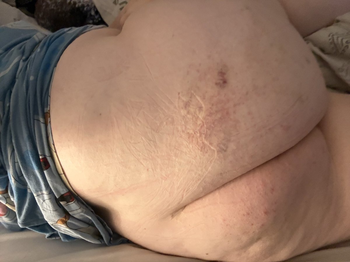 estradiolgang's tweet photo. One cheek is way worse than the other lol https://t.co/mhawdTxnjo
