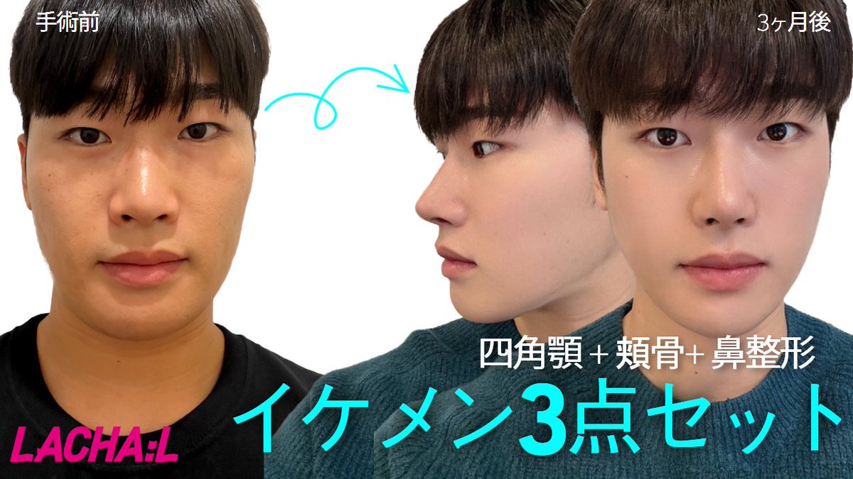 Lachal_JP's tweet photo. この方は普段、目や鼻に加えて顔の形にも不満を抱いていました。
四角顎、頬骨、鼻手術を受けて 完璧なイケメンに変身！
＃韓国整形
＃美容外科
＃四角顎
＃頬骨
＃鼻整形
＃Lachal

申し込みはこちらえ！
🔻🔻🔻
https://t.co/ge1ugwXO1Z https://t.co/RSLiz1sj1h