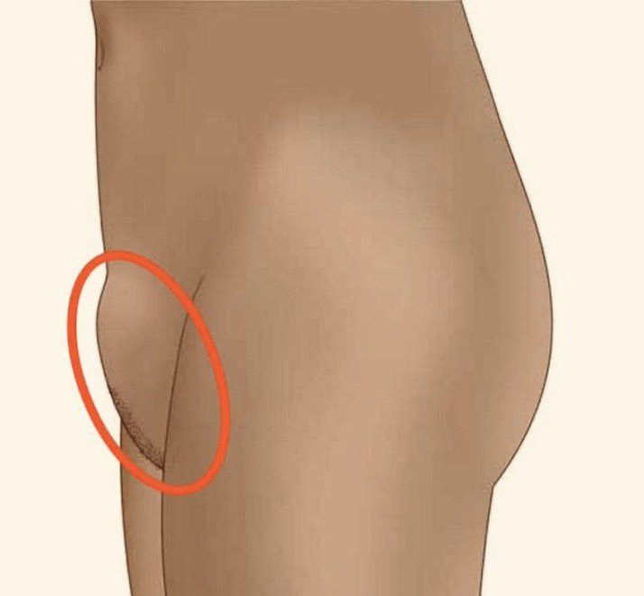 alethea_allyn's tweet photo. Hey @grok I noticed a bump like this on my girlfriend's lower abdomen.Could this cause any harm? https://t.co/idHaIJJUQg