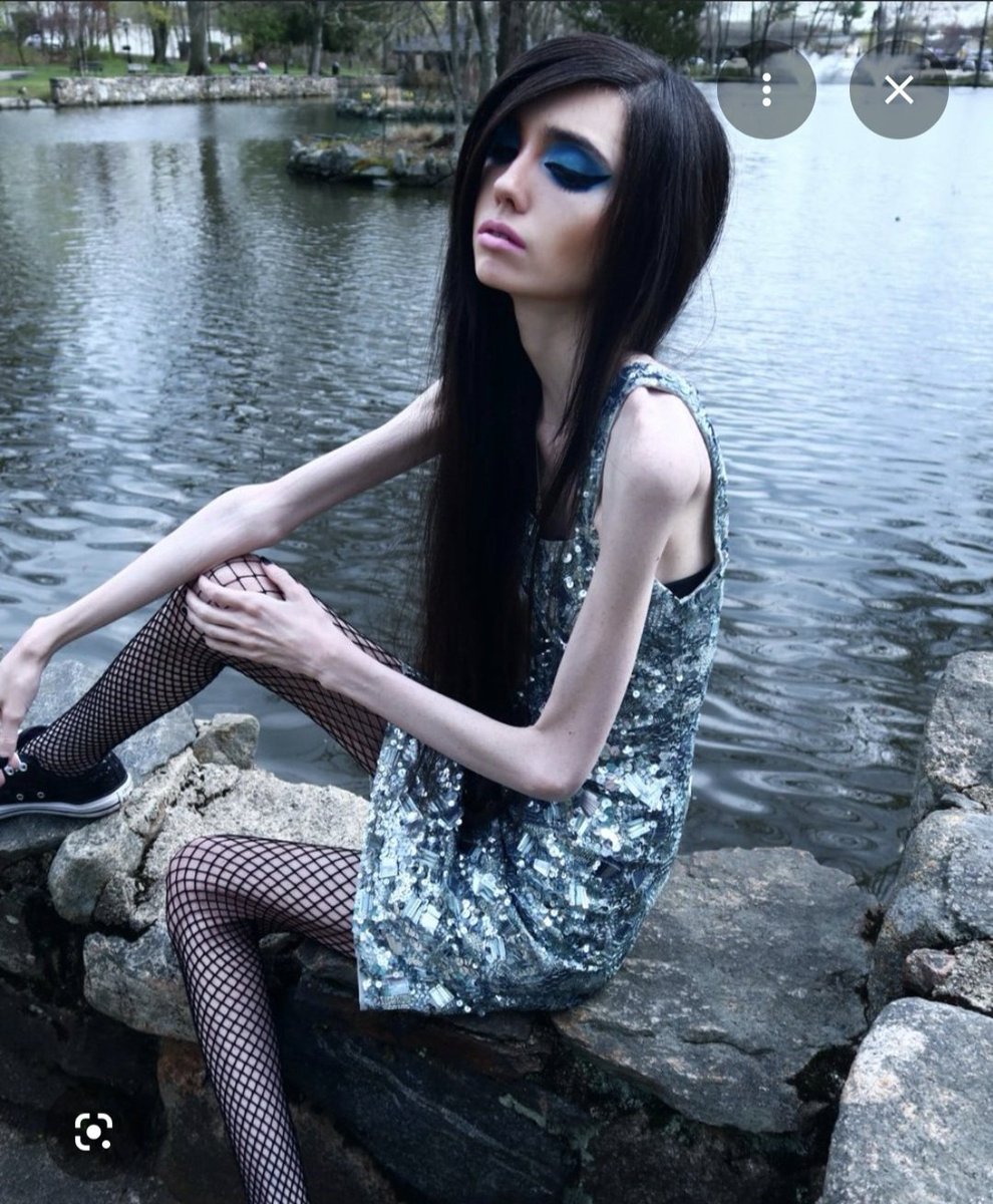 JeNN28653474's tweet photo. How does Eugenia cooney live so long with it? She's literally a walking skeleton! So, they definitely can survive awhile! Eugenia is actually living proof of that, I wondered at times how that girl even stood up. She is a huge fan of Disney and would go and walk around for hours, I just don't understand how her body allows it. She would start coughing while live on twitch and get up and go into the bathroom instead of drinking water. The girl never even sipped water and would be live for hours. This disease is so sad, such a nice girl, the disease takes them over!