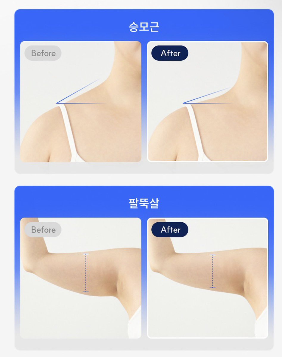 baguriee's tweet photo. #광고 #rt이벤트 
지금 바다로 돌아가야 되는 거북목 직장인 주목 
인스타 바이럴난 그 기기 세일 열어드립니다

바르너 EMS 미니스팟 세일 ~ 8월 6일까지
https://t.co/vcoKtHBBEq

 👊무게 & 디자인: 51g 초경량, 목걸이형
 
♨️온열 모드: 3단계 온열 기능으로 따뜻하게 순환 및 탄력 케어 동시 가능

 👊출력 및 모드: 고출력, 총 15단계 강도 조절, P1~P6 6가지 모드(복합, 스트레칭, 두드림, 펄스, 릴렉스, 지압)

✅전용 젤이 필요 없어 간편

 👊어딜 조질 수 있습니까: 부유방, 승모근, 손목, 팔뚝, 허벅지 등 

 🙂‍↕️추천인 ? : 
운동해도 안 빠지는 팔뚝 군살, 솟은 승모근(부기), 거북목이 고민인 직장인✅

🫳🏿붙이고 일하면서 일상 생활 가능 (가벼워서)
🫳🏿여름철 나시, 오프숄더, 부유방 관리템

집사는 피부 수분에 따라 EMS 자극이 다를 수 있다고 생각해. 그래서 촉촉한 젤 또는 크림을 바른 후 사용하는 걸 추천드립니다.