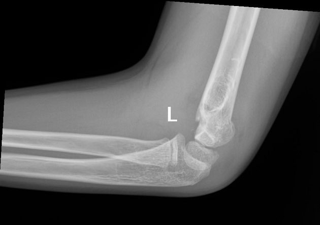 DrAyubaD's tweet photo. 6-year-old child with elbow pain and deformity after fall on outstretched hand.

Elbow X-ray (lateral view).

What special line can used to quickly rule out a fracture? (😉)

What specific sign is shown in this elbow?

Now what is your final diagnosis ? https://t.co/izosO2rKwY