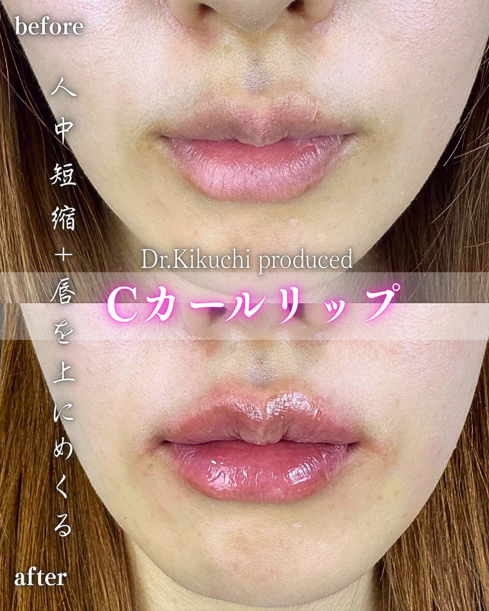 lula_kikuchi's tweet photo. 新潟でDr菊地のカスタマイズ唇ヒアル💉
cuteな唇をヒアルロン酸で👨‍⚕️

しこり、感染、左右差など
価格33000-77000円

#ルラ美容クリニック 
#ルラ美容クリニック新潟院
#新潟 https://t.co/wVfNWERNkG