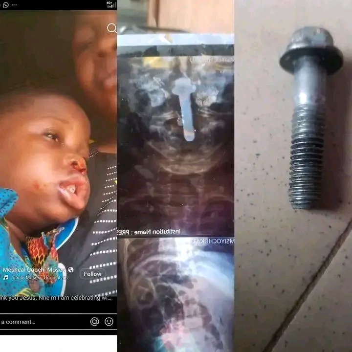 Pascaldey4you's tweet photo. this little boy accidentally swallowed a long bolt (shown in the picture), which became lodged in his throat for three days, causing bl€€ding and severe distress. 

The parents of the boy took him to several hospitals, but many doctors were unable to help and referred them elsewhere.

While they were on the way to Nnamdi Azikiwe University Teaching Hospital (NAUTH), Nnewi, something extraordinary happened. 

while inside a bus, the boy suddenly started  vomiting and finally the bolt came out, bringing an end to the frightening ordeal.

The mother described the incident as a miracle and gave all the glory to God for saving her son's life.

Do you still doubt if God exists ?