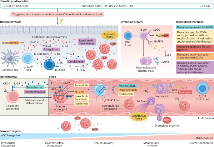 NatRevRheumatol's tweet photo. New content online: Advances in the treatment of eosinophilic granulomatosis with polyangiitis https://t.co/kDHVQ2kTi4 https://t.co/53fBHP3OTu
