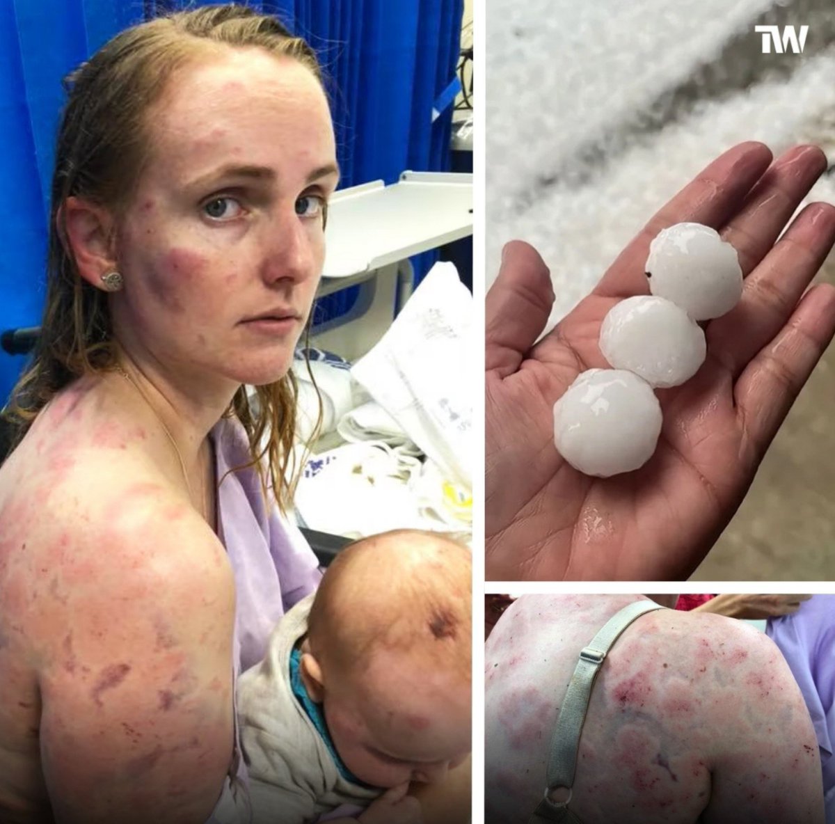 histories_arch's tweet photo. During a violent hailstorm in Queensland, an Australian mother found herself trapped outside as hailstones the size of golf balls began smashing down around her. With no time to reach shelter, she instinctively wrapped her body around her infant daughter, crouching over her on the ground as ice chunks hammered her back, arms, and face. The storm was so intense that car windshields shattered, roofs dented, and emergency services were overwhelmed by calls from families caught in the open.

As the hail intensified, the mother absorbed dozens of direct hits, each one leaving deep bruises, cuts, and swelling. She later said she didn’t feel the pain in the moment, only the fear that one stray hailstone could strike her baby’s head. Photos taken afterward show her covered in purple welts while her daughter, protected beneath her, escaped with only minor marks. The contrast between their injuries became a visceral symbol of what parental instinct looks like under extreme pressure.

When the storm finally passed, neighbors rushed her to medical care, where doctors treated her injuries and praised her quick thinking. The story spread across Australia and beyond, resonating as a raw example of courage in an everyday setting, no hero costume, no dramatic rescue team, just a mother who became a human shield without hesitation. Her experience also highlighted how increasingly unpredictable extreme weather events can turn ordinary moments into life‑or‑death decisions.

What rarely gets mentioned is how long the aftermath stayed with her. In the days following the storm, she struggled to lift her arms, couldn’t sleep on her back, and had to rely on neighbors for basic tasks while caring for her baby. 

She later admitted she felt embarrassed walking into the hospital, worried people might assume something else caused her injuries. It wasn’t until doctors saw the pattern of the bruises and the hail‑stone dents on her car that they understood the full scale of what she endured. That quiet vulnerability, the part after the heroism, is what makes her story resonate even more.

#archaeohistories