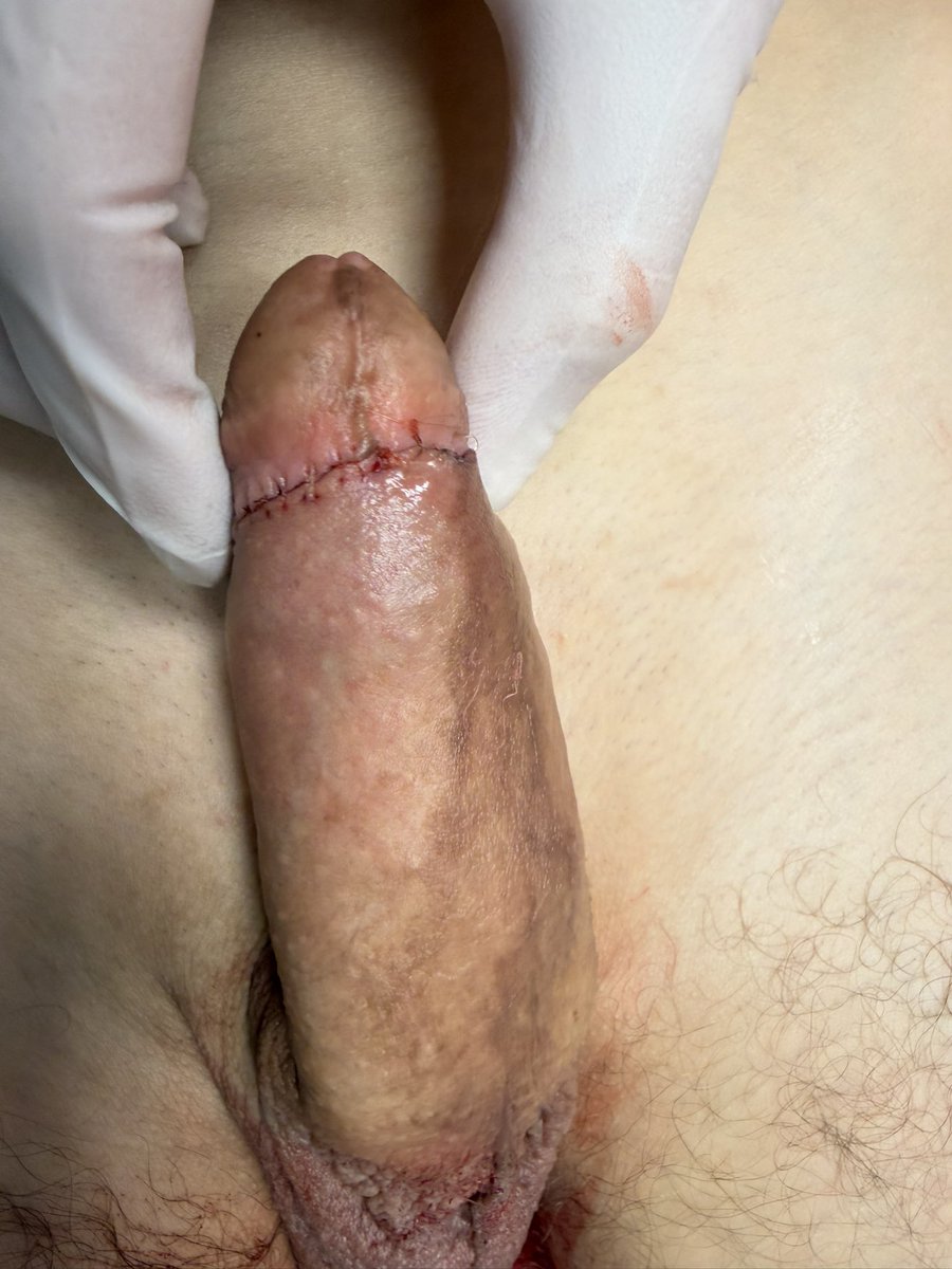 drEPawlowska's tweet photo. Bezpośrednio po i tydzień po całkowitym laserowym obrzezaniu. Szybki proces gojenia.
#circumcision
#malecircumcision
#medicalcircumcision
#surgicalcircumcision
#adultcircumcision
#lasercircumcision https://t.co/Gc3HXVqtU5