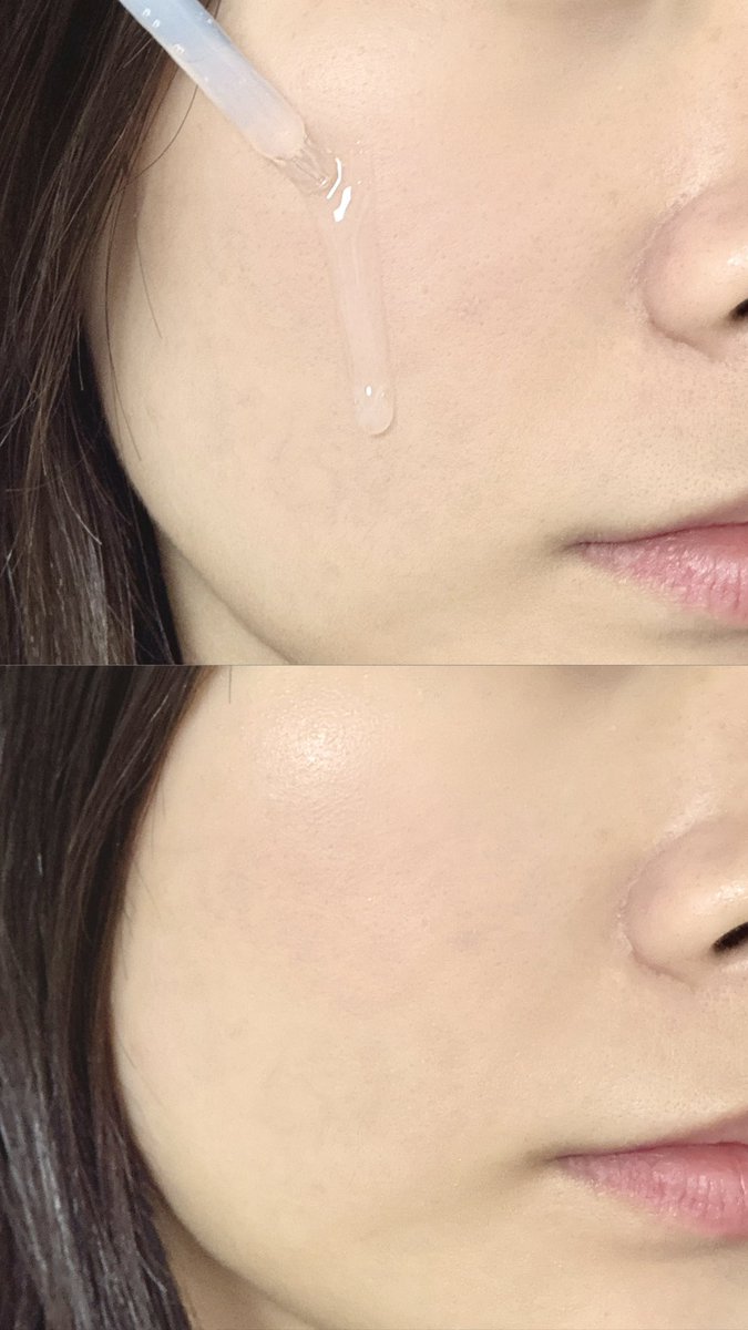 mood_swiing's tweet photo. #RT이벤트 #광고
💧RT하신 3분께 메디힐 마데카소사이드 더마세럼을 보내드려요

업그레이드된 #수분흔적세럼‼️
↳ https://t.co/Bb04TP5iHT

기존 세럼보다 더 수분감 가득하고
흔적/진정 케어까지 알잘딱깔센이라 사계절 내내 사용하기 좋은 데일리 세럼으로 완성••

트러블 붉은기가 오래 남는 편이라 이런 진정+수분 세럼은 꾸준히 쓰는데 메디힐 더마세럼은 계속 손이 가는 세럼이라 매우 추천합니다★.ᐟ