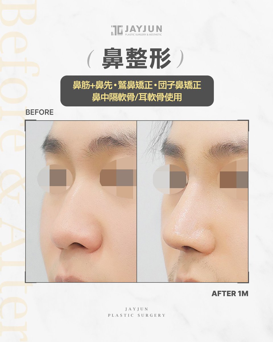 jayjun_jpn's tweet photo. ✦ JAYJUNメンズ鼻整形｜鼻筋＋鼻先｜団子鼻矯正 ✦

「鼻先が丸い」
「横顔にメリハリが出ない」
「鼻筋から鼻先のラインを整えたい」

手術名：鼻筋＋鼻先／鷲鼻矯正／団子鼻矯正。

鼻筋の高さだけでなく、
鼻先の丸み・鼻筋のライン・横顔全体のバランスを確認し、
鼻中隔軟骨と耳軟骨を使用して自然に設計しました。

もともとの骨格や皮膚の厚みに合わせて、
鼻筋から鼻先までのラインを整えることで、
派手すぎず、端正な横顔へ。

術後1ヶ月の時点ではまだ腫れが残る時期ですが、
鼻先の重さが軽減され、
横顔の印象がすっきりと整ってきています👃🏻✨

男性の鼻整形は、
「高さ」だけではなく、
鼻筋・鼻先・口元とのバランスまで含めて設計することが大切です。

別角度の症例写真は画像でご確認ください。

#メンズ鼻整形 #男性鼻整形 #鼻整形 #鼻筋整形 #鼻先整形 #団子鼻 #鼻先が丸い #鷲鼻矯正 #韓国鼻整形 #江南美容外科 #渡韓整形