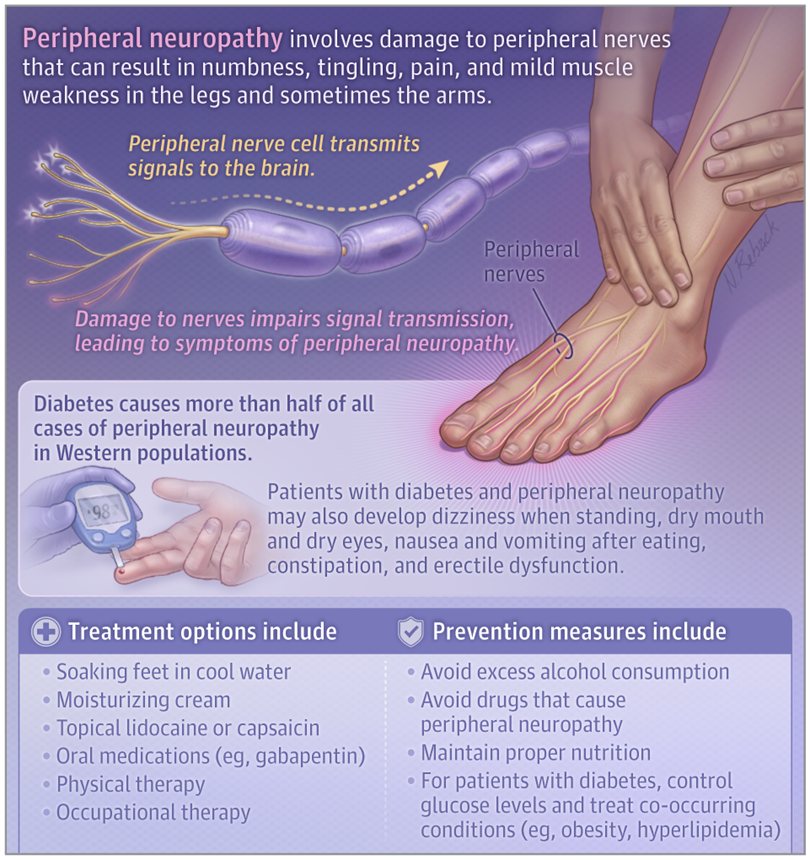 JAMA_current's tweet photo. #Peripheral #neuropathy involves #nerve damage that can cause numbness, tingling, pain, and mild muscle weakness in the legs and, sometimes, the arms. 

📄This JAMA Patient Page describes common symptoms, diagnosis, and treatment of peripheral neuropathy. 

https://t.co/nLlkNV7aRS