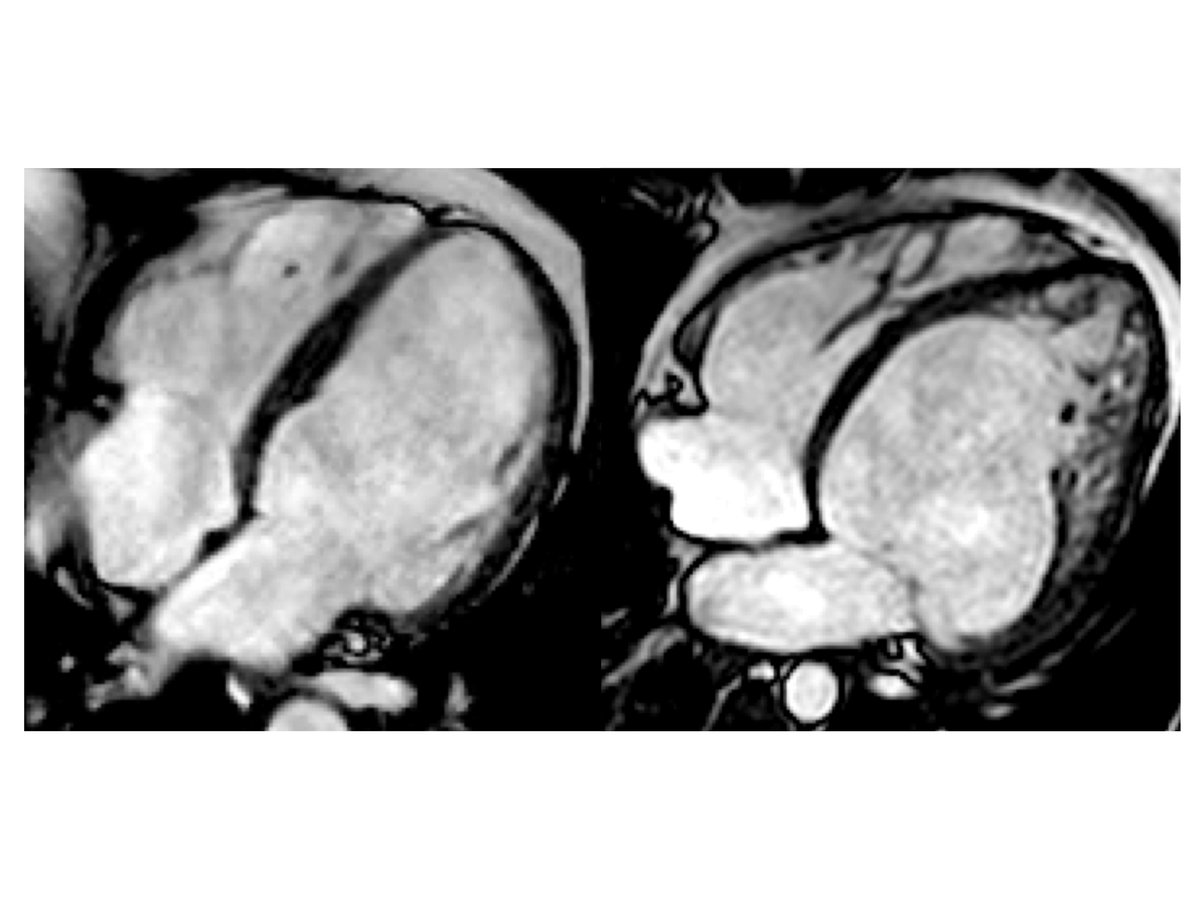 CNIC_CARDIO's tweet photo. 🫀 🧬 The largest genetic and #MRI study carried out to date rules out the existence of a heart condition: left ventricular hypertrabeculation, which is not associated with a poorer prognosis in patients with #dilated cardiomyopathy.
This research was carried out by a team from @CNIC_CARDIO in collaboration with a wide-ranging international network of hospitals and research centres, led by @dr_pavia, head of the CNIC’s hereditary cardiomyopathies group and a cardiologist at @HospiPtaHierro and the CIBERCV (@ciberisciii).
🔗 DOI: doi:10.1161/CIRCULATIONAHA.125.078536. #OpenAccess in @CircAHA
📰 Read the full news article here: https://t.co/MJEsaXpkOd
#CNIC #CardiovascularResearch #Science