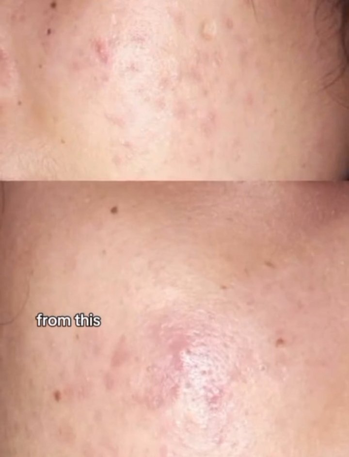 Raradew0's tweet photo. Hasil dari moist 30rb an aja♡
Bukti kalau sembuh itu ga harus mahal! 
Kunci nya : sabar, konsisten dan cari sunscreen yang non comedogenic
Fw➹ https://t.co/UAi2y195ip
Moist ➹ https://t.co/EQkVwEr08X
Sunscreen ➹ https://t.co/3FxWswZB7P https://t.co/aVwUJ6i79f
