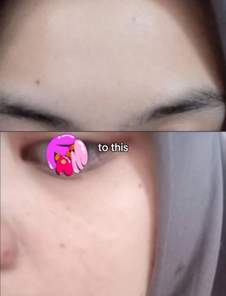 Raradew0's tweet photo. Hasil dari moist 30rb an aja♡
Bukti kalau sembuh itu ga harus mahal! 
Kunci nya : sabar, konsisten dan cari sunscreen yang non comedogenic
Fw➹ https://t.co/UAi2y195ip
Moist ➹ https://t.co/EQkVwEr08X
Sunscreen ➹ https://t.co/3FxWswZB7P https://t.co/aVwUJ6i79f