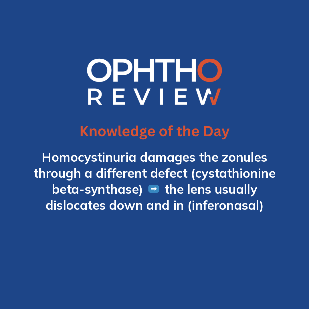 ophthoreview's tweet photo. Marfan syndrome

#ophthoreview #ophthalmology #ophtho #ophthalmologyresidency #ophthalmologist #surgicaleducation #medicaleducation #meded #surgery #medicalstudent #medicine #medicalschool #resident #residency https://t.co/tSmntftDWF