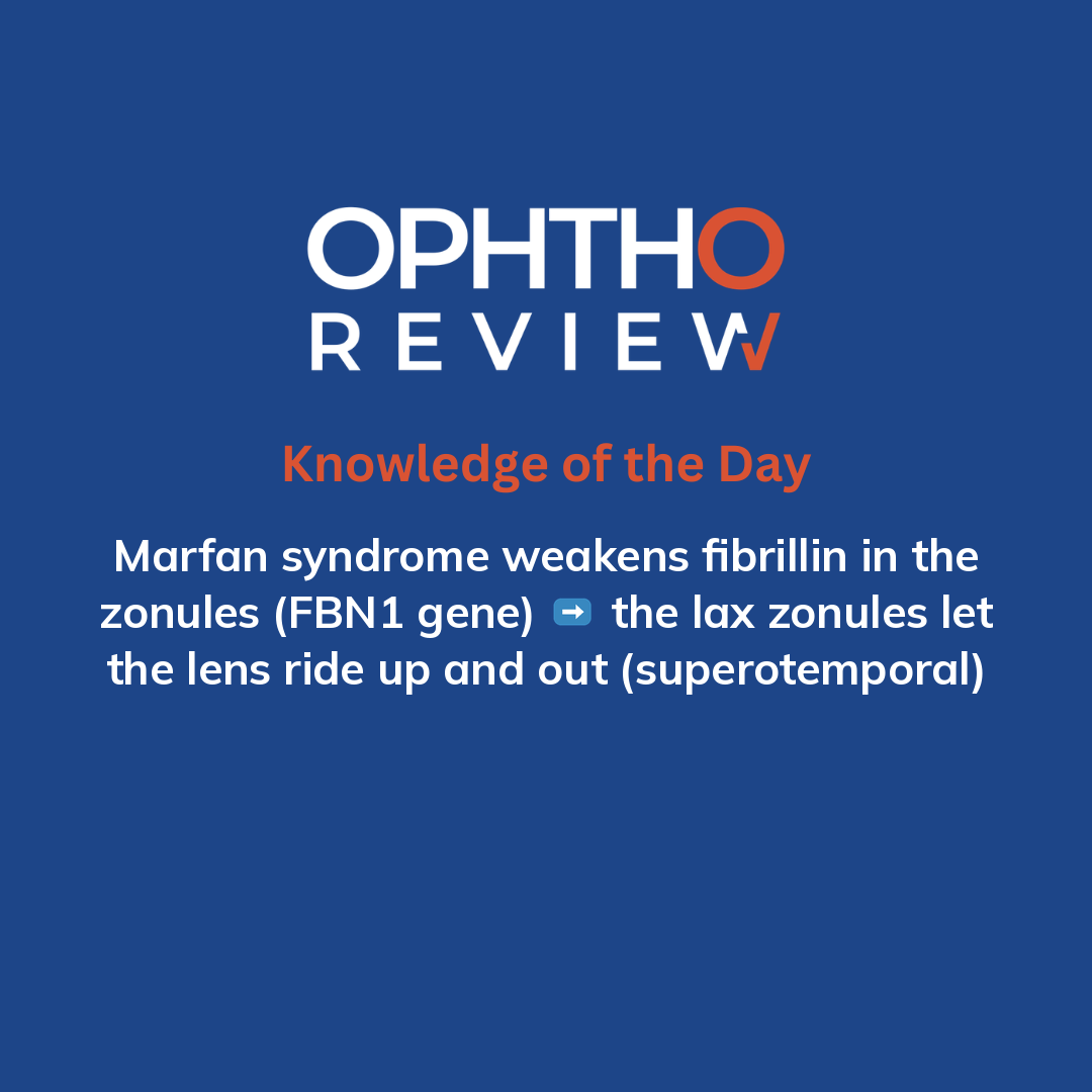 ophthoreview's tweet photo. Marfan syndrome

#ophthoreview #ophthalmology #ophtho #ophthalmologyresidency #ophthalmologist #surgicaleducation #medicaleducation #meded #surgery #medicalstudent #medicine #medicalschool #resident #residency https://t.co/tSmntftDWF