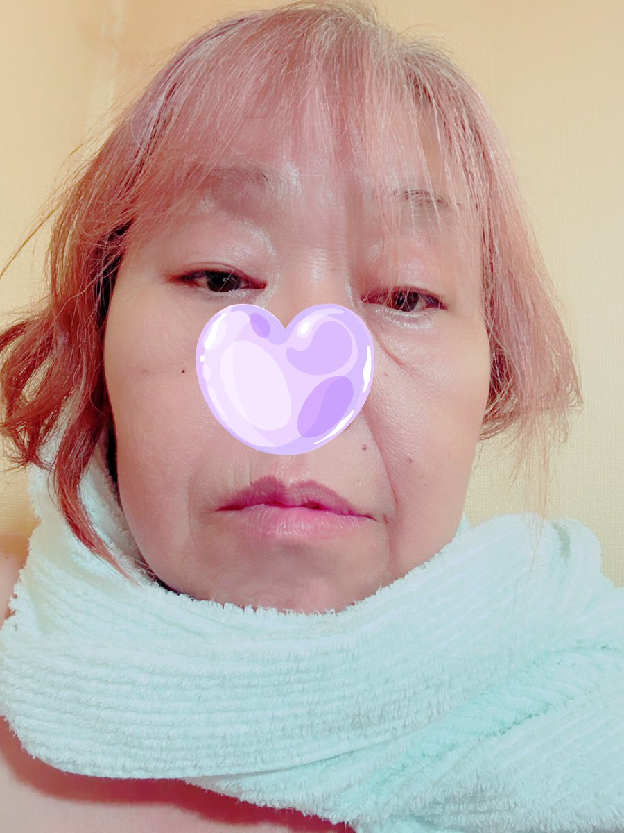 apororui's tweet photo. まー…まだ少し曲がってはいるけど…だいぶ顔面麻痺も回復した。が、多分コレが精一杯の回復らしい。。多少曲がってしまってるのは麻痺の後遺症とでも言うべきか🌀
まぁ、死ぬような病気では無いだけ良しとしときます https://t.co/66unMSqVwj