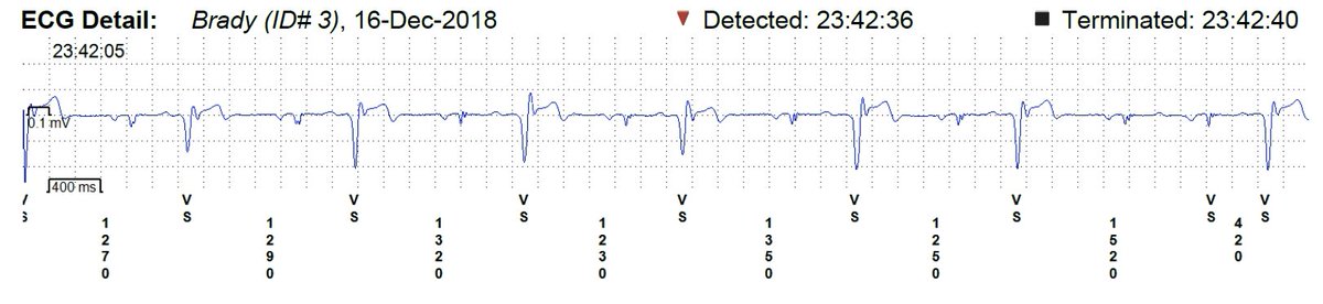 chris_monkhouse's tweet photo. An ILR called this a brady episode.

What is actually going on here?

My analysis tomorrow.

#EPeeps #EGeMs #Electrophysiology https://t.co/xXgiQv0Few