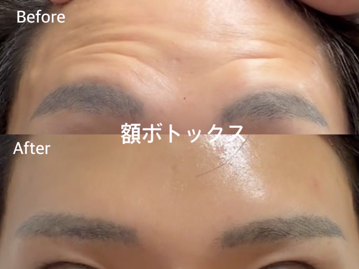 aloeclinic's tweet photo. 25歳超えると肌がコラーゲンを生成する力が減ってくるので、美容医療してるかしてないかで正直めちゃくちゃ差出てきます。

クリニックスタッフが絶対というほどやってる＆痛みやダウンタイムも少ないのは、
圧倒的に「ピコトーニング（4,000円）」です。
なんか肌綺麗になった？白くなった？って言われる機会がめちゃくちゃ増えます。（1枚目はピコトーニング定期のビフォアフ）
ララドクターも組み合わせると肌が発光してきます。

あと3ヶ月に一回額、眉間のボトックス（1部位1,000円）もみんなやってます。

あと肌が綺麗すぎるツヤッツヤな人は
肌育注射やってます。
（ジュベルック2cc16,000円）
ご参考までに！