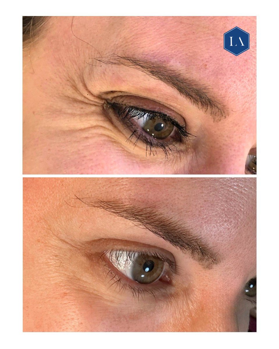 LuxtonAesthetic's tweet photo. Real people. Real Results.
Before & After. ✨ Turn back the clock on tired eyes.
Those little lines that appear when you laugh or smile—your crow’s feet—can be softened to reveal a fresher, more radiant you.
#CrowsFeet #AntiWrinkle #LuxtonAesthetics #EssexClinics #KentClinics https://t.co/7gczOX3jYW
