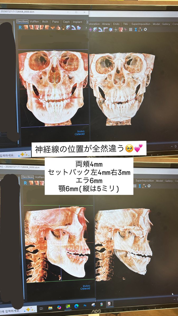 kg64d's tweet photo. 【@batangjp】にて輪郭3点➕額挙上をして、術後1���間が経過しましたᝰ✍🏻
＃バタン美容外科 ＃輪郭3点 ＃額挙上 https://t.co/3pfRouqNmn