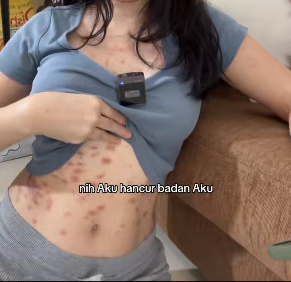 biduanssa's tweet photo. "awalnya cuman kecil areanya, tapi lama-lama bisa jadi sebadan ini gatal dan merah-merah gini"

ini namanya ✨️K U D I S✨️ alias scabies.

bayangin ada tungau super kecil yg bikin terowongan sibawah kulit kamu, behhhh aku ngetik sambil garuk2 nih sangking kebayang gatalna😭

ada yang pernah ngalamin kudisan/scabies gini gak?