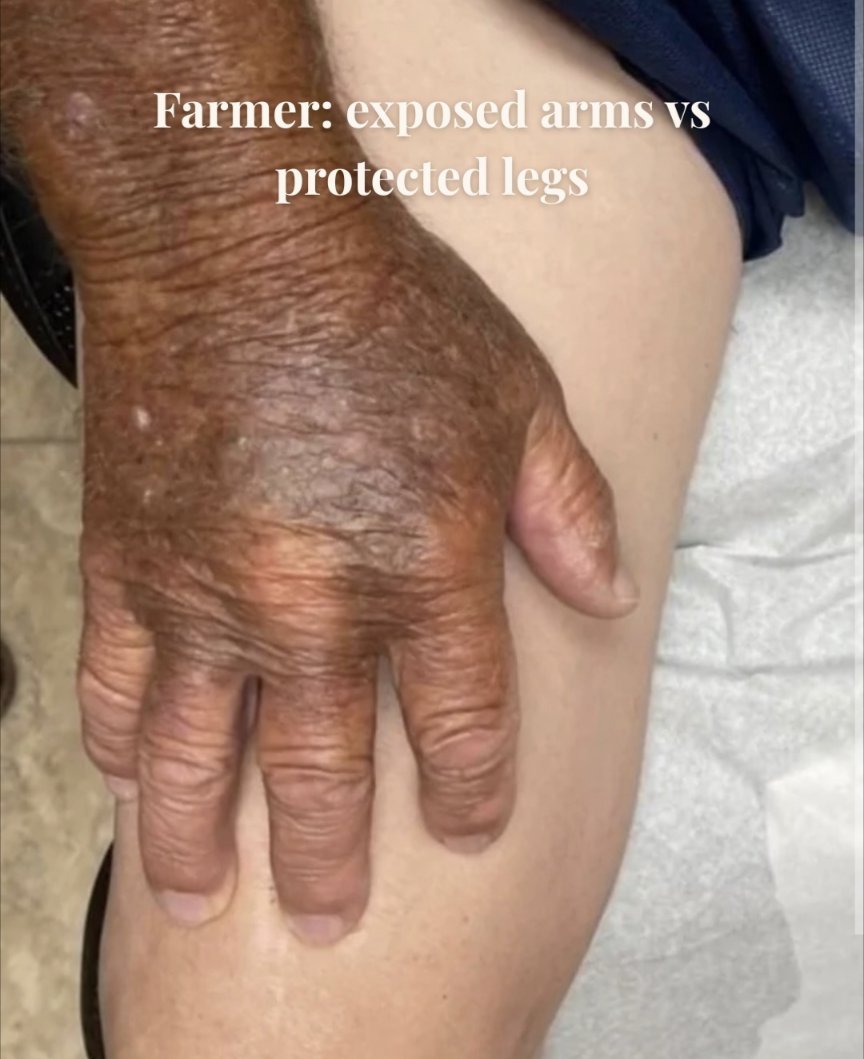 aspecctu's tweet photo. Funny how every 'muh bad ingredients in sunscreen' tanning coper inevitably looks 20 years older https://t.co/Ciwua53o2e