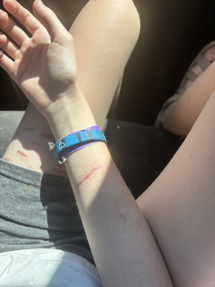 Froggie_27's tweet photo. My scars today <3 #shtwt #shedtwt #slittwt 
FAKE SFX https://t.co/atL7pFd00l