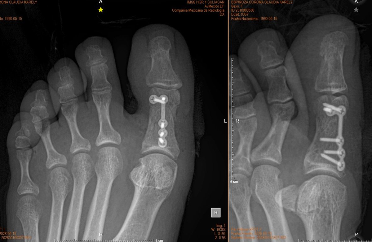 Torlsteinacst's tweet photo. Un dedito del pie más salvado 
#tyo #orthopedia https://t.co/XMJiBBW39x