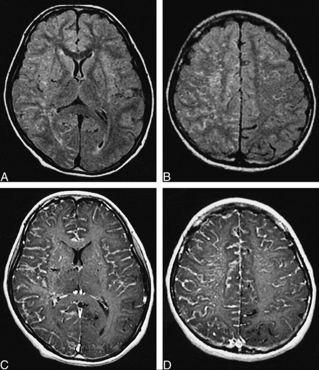 DrAyubaD's tweet photo. Child with recurrent transient ischemic attacks and headaches.

What is the name of this classic sign? 

What is the diagnosis? https://t.co/5Hq2pSf1wj