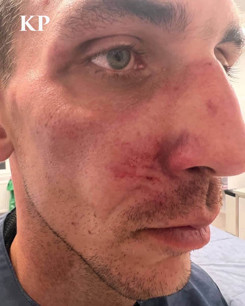 KyivPost's tweet photo. Three Ukrainians were attacked at a hostel in Poland after a man allegedly shouted “go back to Ukraine” over music playing from their car and returned with others.

The victims suffered head injuries. Ukraine’s Consulate says it is in contact with the victims and Polish authorities, while police are investigating the attack.