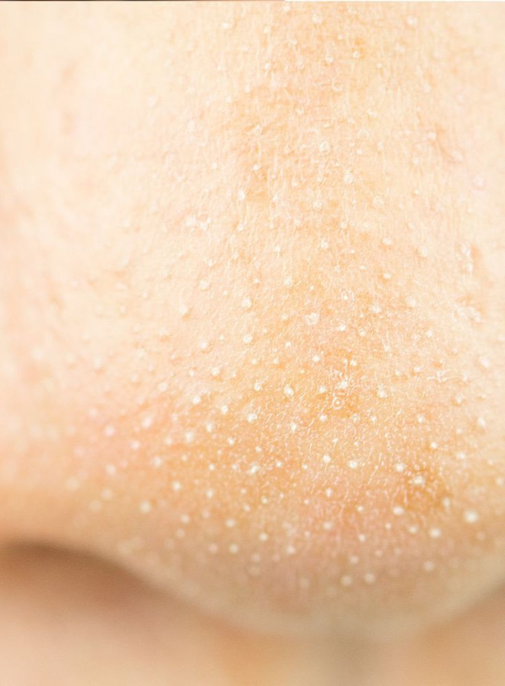 zerozeromilktea's tweet photo. 𝐌𝐞𝐝𝐢𝐜𝐚𝐥 𝐌𝐨𝐧𝐝𝐚𝐲𝐬 #𝟐
A lot of people confuse sebaceous filaments for acne, when they're actually a normal part of your skin! They actually help keep oil flowing freely like it's supposed to. Don't squeeze them, it just hurts your skin! https://t.co/54JG5CXUzg