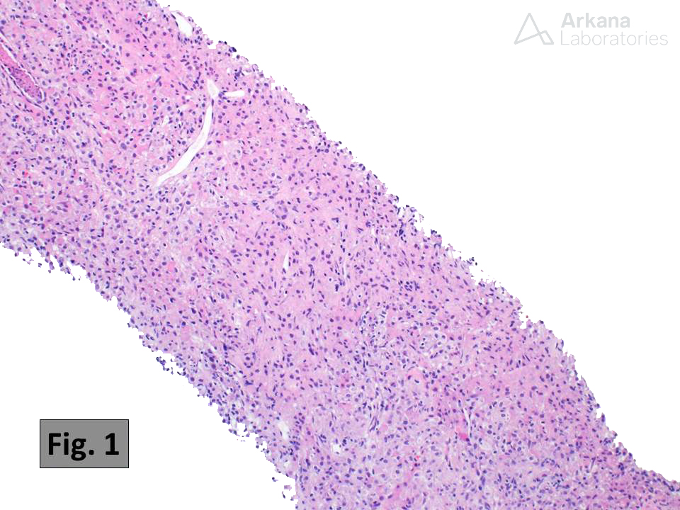 arkanalabs's tweet photo. This kidney biopsy shows the histologic features characteristic of malakoplakia, which includes a dense, often obliterative, inflammatory infiltrate rich in histiocytes (Fig. 1 and 2) with numerous small intracytoplasmic concretions known as Michaelis-Gutmann bodies (these are best identified using histochemical staining for calcium as in Fig. 3). Malakoplakia is thought to result from chronic bacterial infection of the urinary tract (the most common causative organism is E. coli). Many cases are associated with the formation of small plaques and/or mass lesions. The bladder is the most common site of involvement, but kidney involvement occurs in about 15% of cases. The differential diagnosis includes xanthogranulomatous pyelonephritis.  

Reference:
Kobayashi A, et al. Malakoplakia of the kidney. Am J Kid Dis. 2008 Feb;51(2):326-30. PMID: 18215711.

#TeachingPoints #kidneypath #renal #pathology
