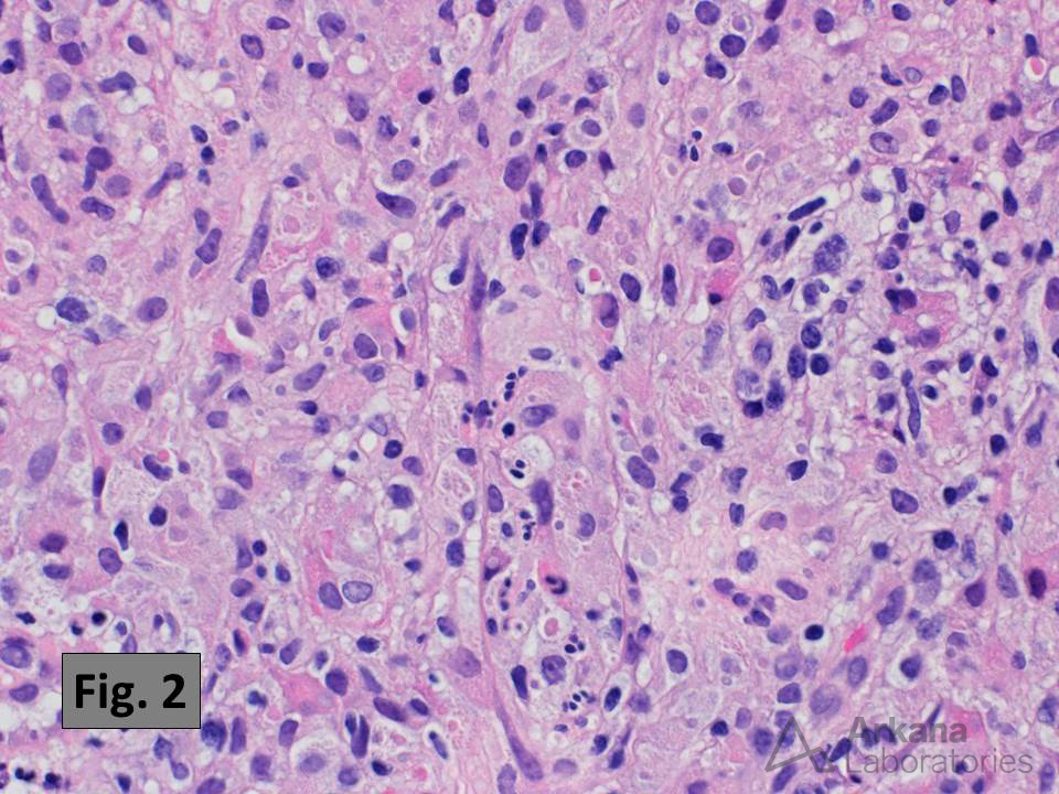 arkanalabs's tweet photo. This kidney biopsy shows the histologic features characteristic of malakoplakia, which includes a dense, often obliterative, inflammatory infiltrate rich in histiocytes (Fig. 1 and 2) with numerous small intracytoplasmic concretions known as Michaelis-Gutmann bodies (these are best identified using histochemical staining for calcium as in Fig. 3). Malakoplakia is thought to result from chronic bacterial infection of the urinary tract (the most common causative organism is E. coli). Many cases are associated with the formation of small plaques and/or mass lesions. The bladder is the most common site of involvement, but kidney involvement occurs in about 15% of cases. The differential diagnosis includes xanthogranulomatous pyelonephritis.  

Reference:
Kobayashi A, et al. Malakoplakia of the kidney. Am J Kid Dis. 2008 Feb;51(2):326-30. PMID: 18215711.

#TeachingPoints #kidneypath #renal #pathology