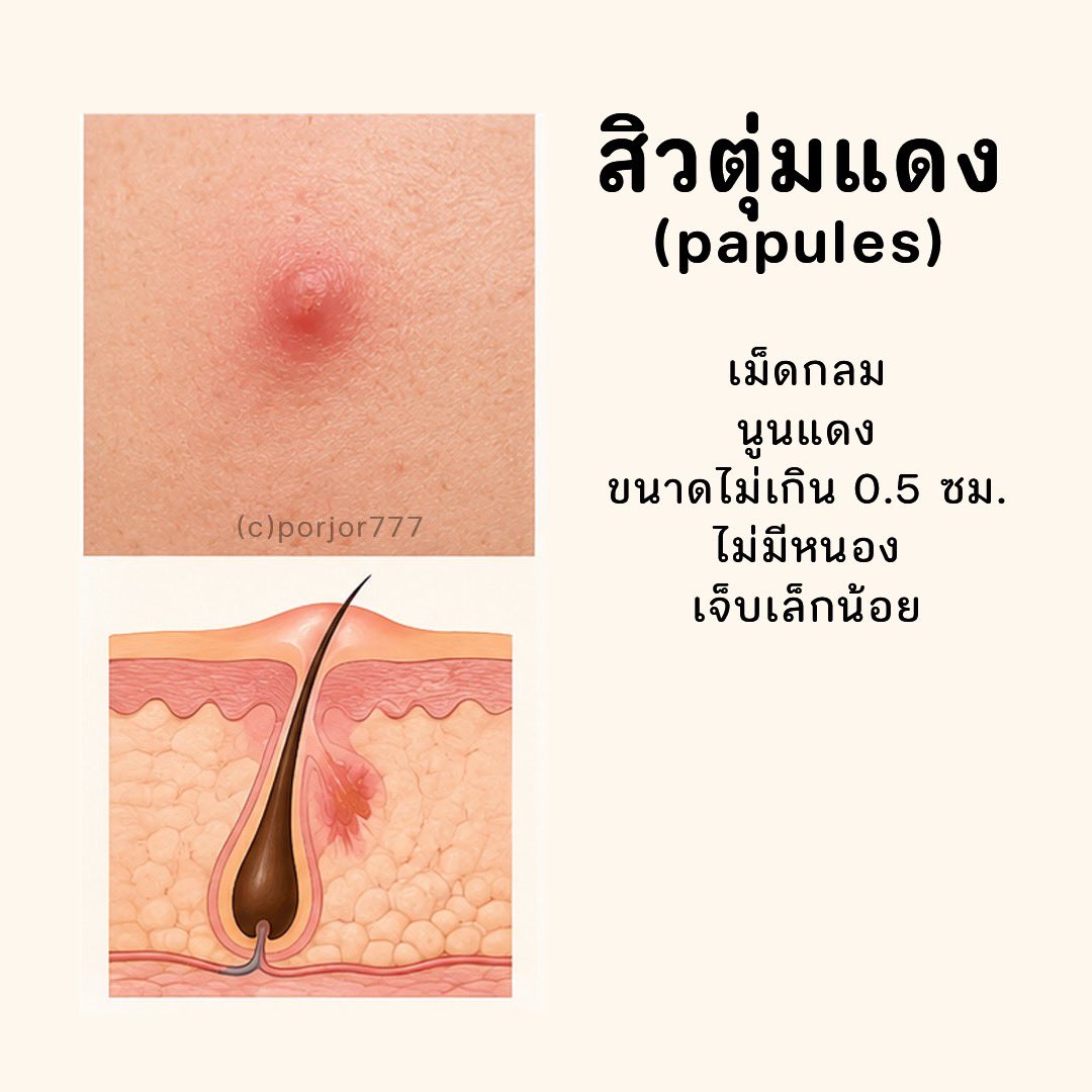 JRXHealthBeauty's tweet photo. สิวอักเสบแต่ละประเภท #สิว #สิวอักเสบ https://t.co/Z43l7a34MF