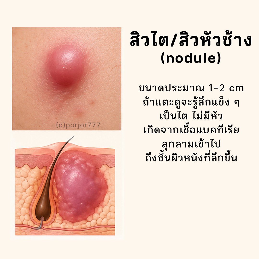 JRXHealthBeauty's tweet photo. สิวอักเสบแต่ละประเภท #สิว #สิวอักเสบ https://t.co/Z43l7a34MF