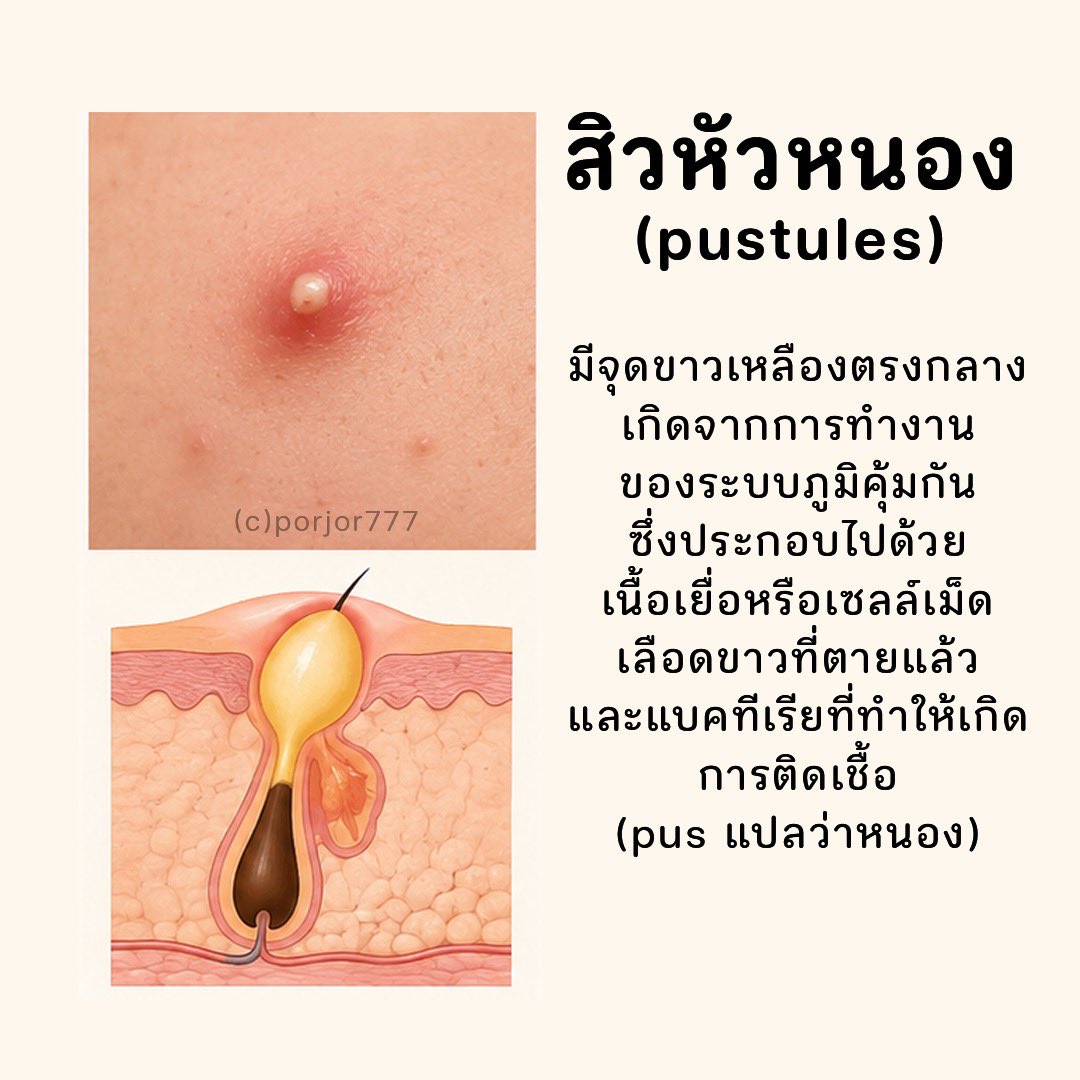 JRXHealthBeauty's tweet photo. สิวอักเสบแต่ละประเภท #สิว #สิวอักเสบ https://t.co/Z43l7a34MF