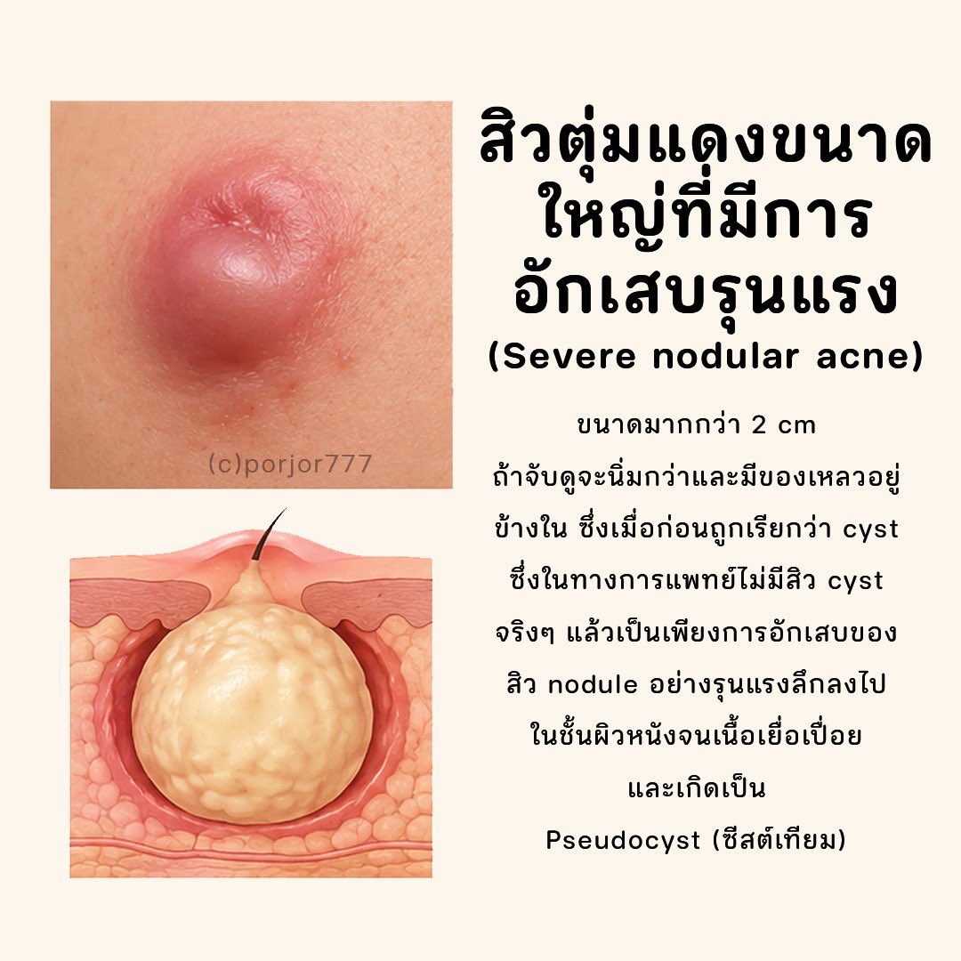 JRXHealthBeauty's tweet photo. สิวอักเสบแต่ละประเภท #สิว #สิวอักเสบ https://t.co/Z43l7a34MF