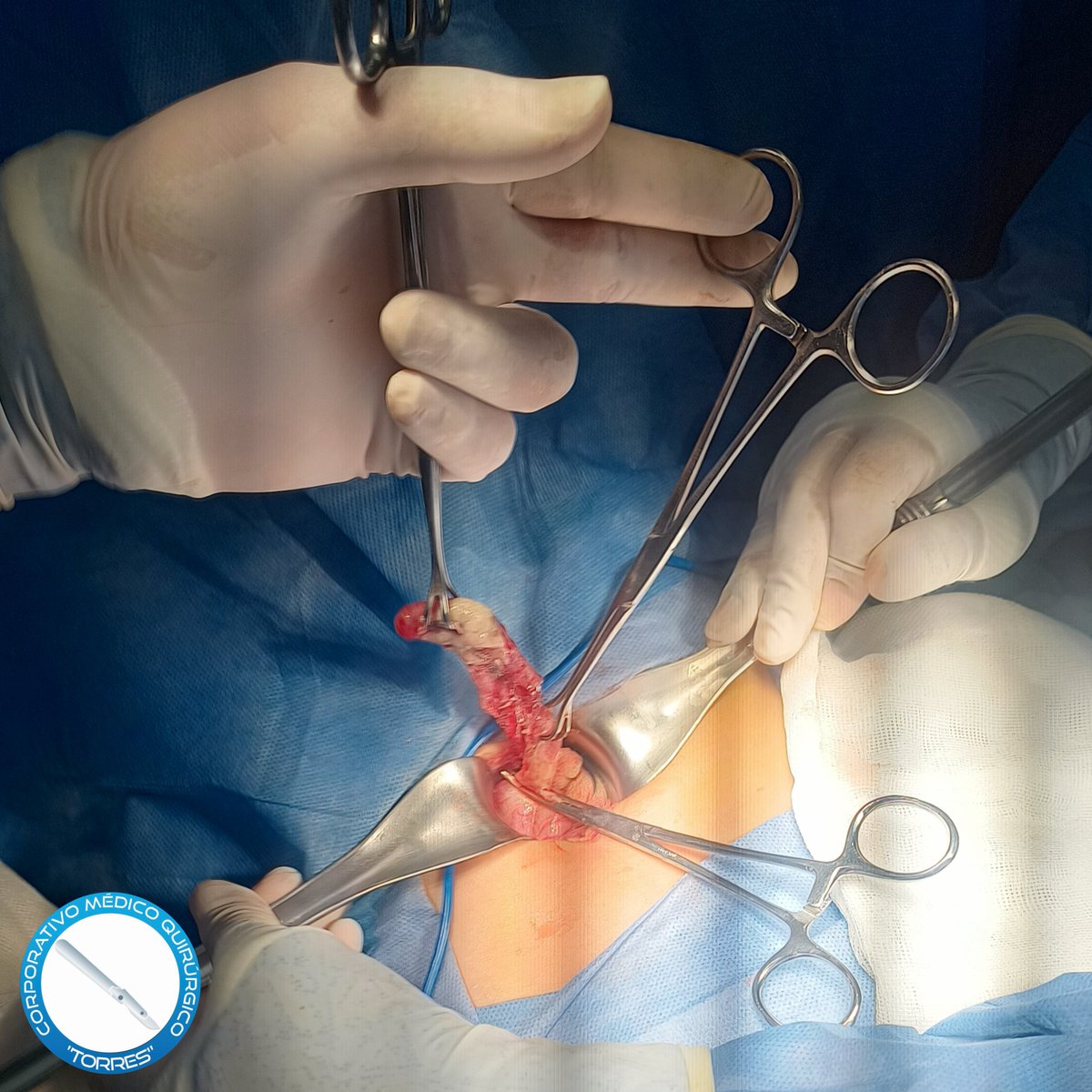 CMQ_Torres's tweet photo. Masculino de 5 años programado para #cirugía de urgencia por #apendicitis.

Citas: 222 963 3387 📱 https://t.co/uWmOb78S4I
