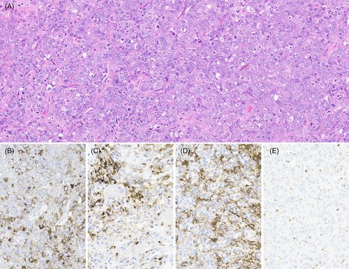 brainpathol's tweet photo. A 30-year-old woman with progressive lower extremity sensory loss and weakness
What is your diagnosis?

Whole slide image: https://t.co/YUTlrHVP0V
Read the full case here: https://t.co/UBFvim0kEr https://t.co/ygPb3dSeay