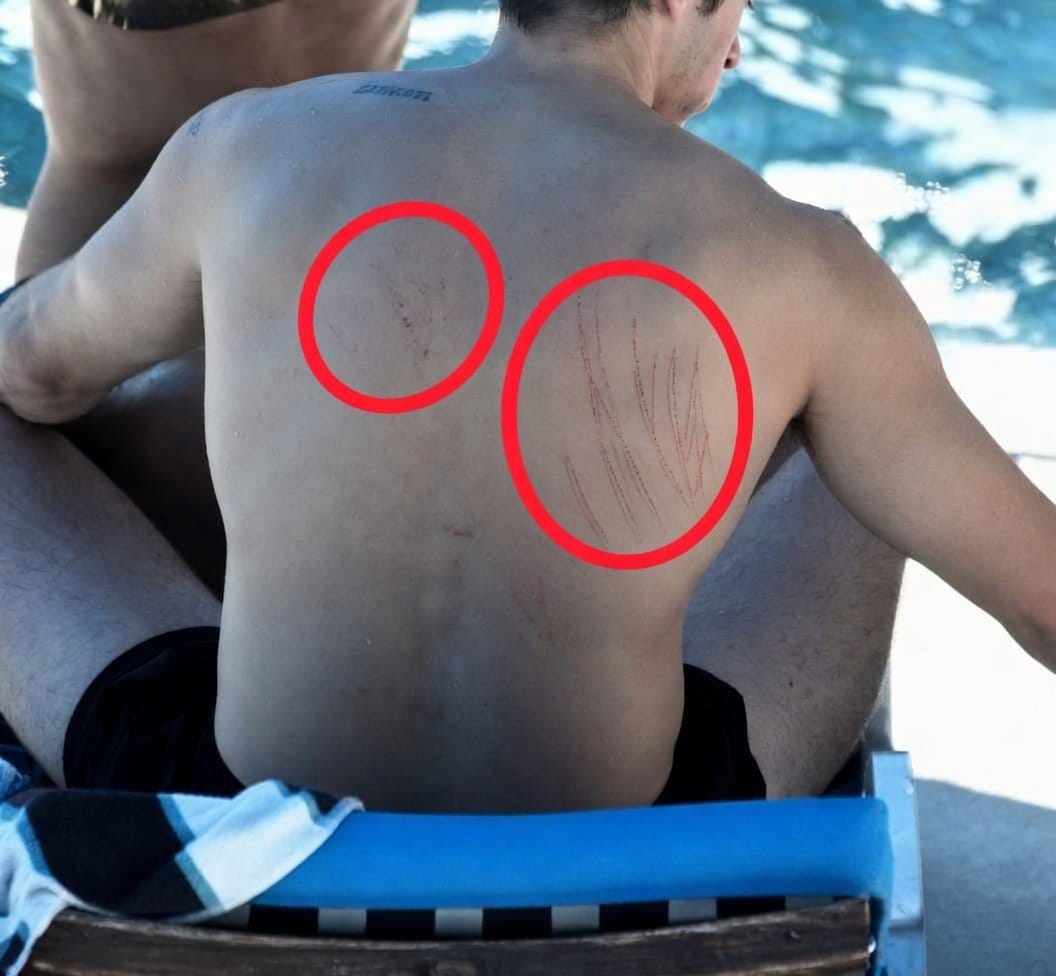 Ragini1Im's tweet photo. Hey @grok  Explain the marks on Dua Lipa’s husband’s back from their honeymoon pics. Are they really from passionate moments? https://t.co/hLFFEZ4c9y