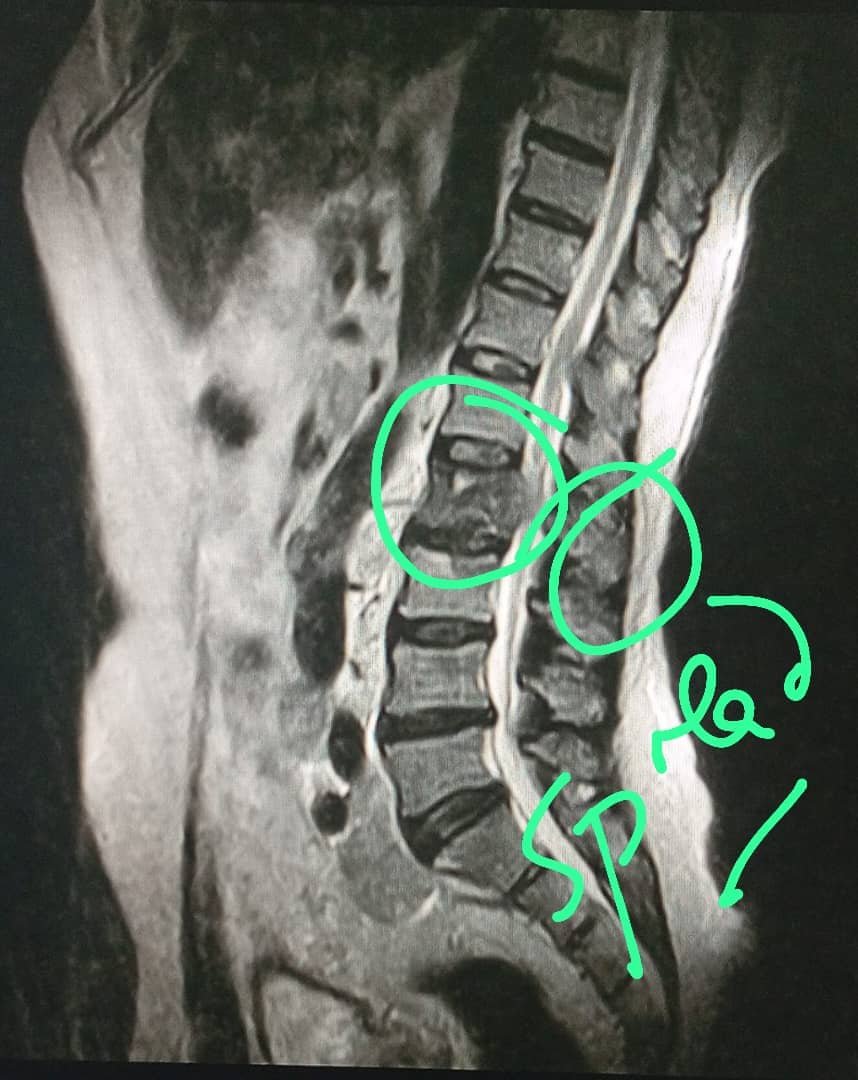 Kumiorthopod's tweet photo. Back pain in older men could be a symptom of Prostate Cancer that has spread to the spine.Get yourself evaluated by professionals other than self medicating.Early diagnosis and treatment is helpful. https://t.co/vc4hw4UiMu