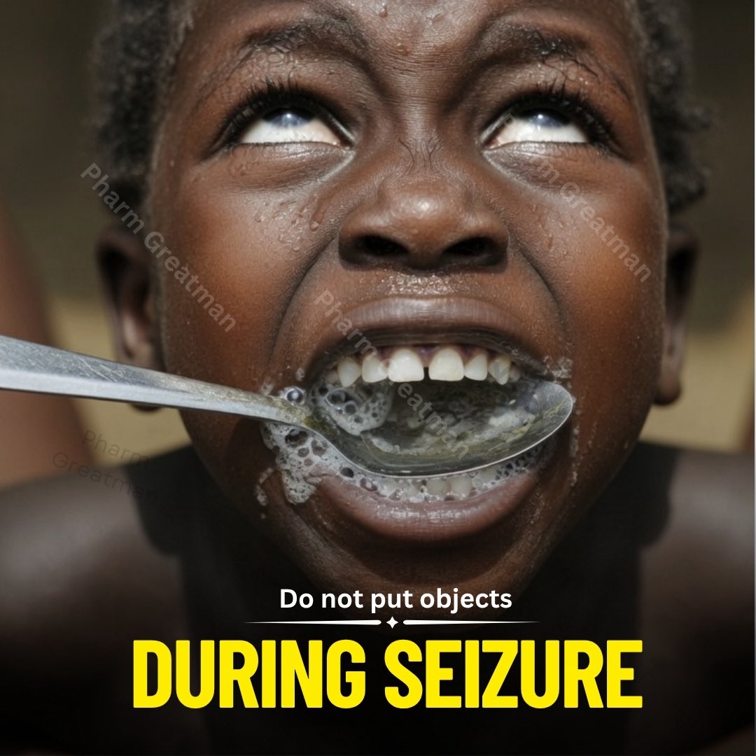 OGreat6's tweet photo. Why giving someone having a seizure something to bite is dangerous.￼ 

Many people still believe that a person having a seizure needs a spoon, stick, cloth, or another object in their mouth to stop them from swallowing their tongue.

This is not true.
A person cannot swallow… https://t.co/sBd4XToxA9