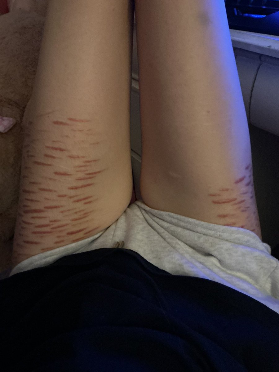 lq1i16's tweet photo. Scar check its been awhile i was having urges last night but didnt give in, i havent cut in about a month🫰 https://t.co/xUVNnY1UZH