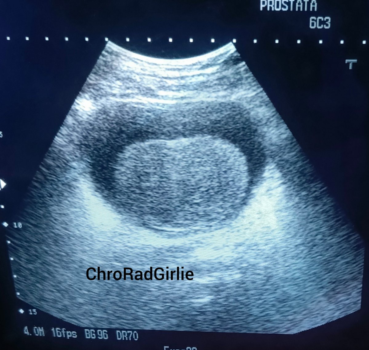 ChroRadGirlie's tweet photo. Kindly observe this sonogram. 
Male patient, with history of frequent urination. https://t.co/jnAgAqBa3r