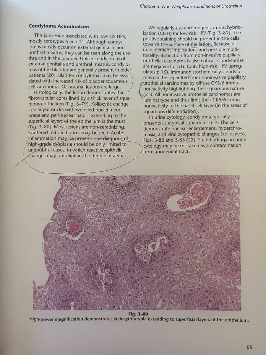 GuannanTiffany's tweet photo. Condyloma acuminatum it is. 😊

Low-risk HPV ISH was positive (not shown).

Diffuse CK5/6 staining and negative GATA3 favor condyloma. In contrast, low-grade papillary urothelial carcinoma typically shows CK5/6 staining confined to the basal layer, while GATA3 may be positive in both entities.

A practical tip from literature (👇): If HPV ISH is unavailable, the CK5/6 staining pattern can provide a useful clue. 

References: 
Montoya-Cerrillo et al. Int J Surg Pathol. 2022.
Velez Torres et al. Hum Pathol. 2022.
Kryvenko, Williamson, and Netto. Survival Guide to Kidney and Bladder Pathology. 2025
https://t.co/vUAUfKRYGJ
https://t.co/FyS1r2IDOb
https://t.co/9ZhOWED4gH