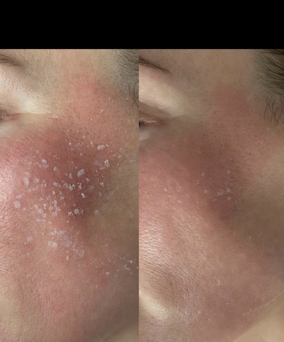 HappySoulStore's tweet photo. Day 1 v Day 7 one of our customers using our GHK-Cu copper peptide tallow balm #tallowbalm #skincare #peptides #beeftallow #beforeandafter https://t.co/B0HK0egFNN