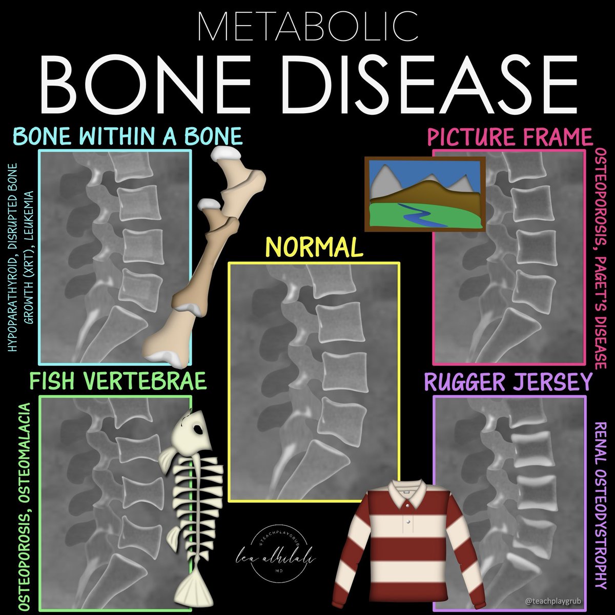 teachplaygrub's tweet photo. Can’t metabolize all the metabolic bone diseases?

When you see weird bones, do you just say, “suggestive of metabolic bone disease” and hope no one asks questions??

Is trying to memorize all their patterns disrupting your homeostasis?

Metabolic disease are complex but there are a few that are a slam dunk

Bookmark this figure for the for the 4 classic xray patterns you NEED to know!