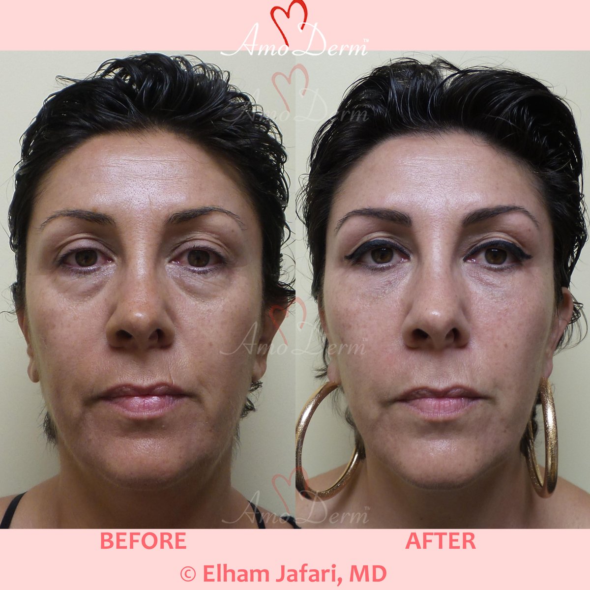 Amoderm's tweet photo. Ending Soon: Complimentary Botox with Filler Treatments - https://t.co/hYveqErAGE https://t.co/eq04AQKsGL
