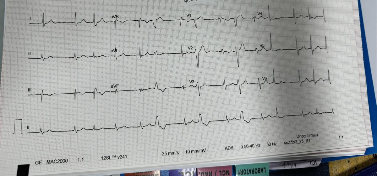 HiraaliCardio's tweet photo. ECGs like this

Diagnosis ? https://t.co/1W0oDSTOAO